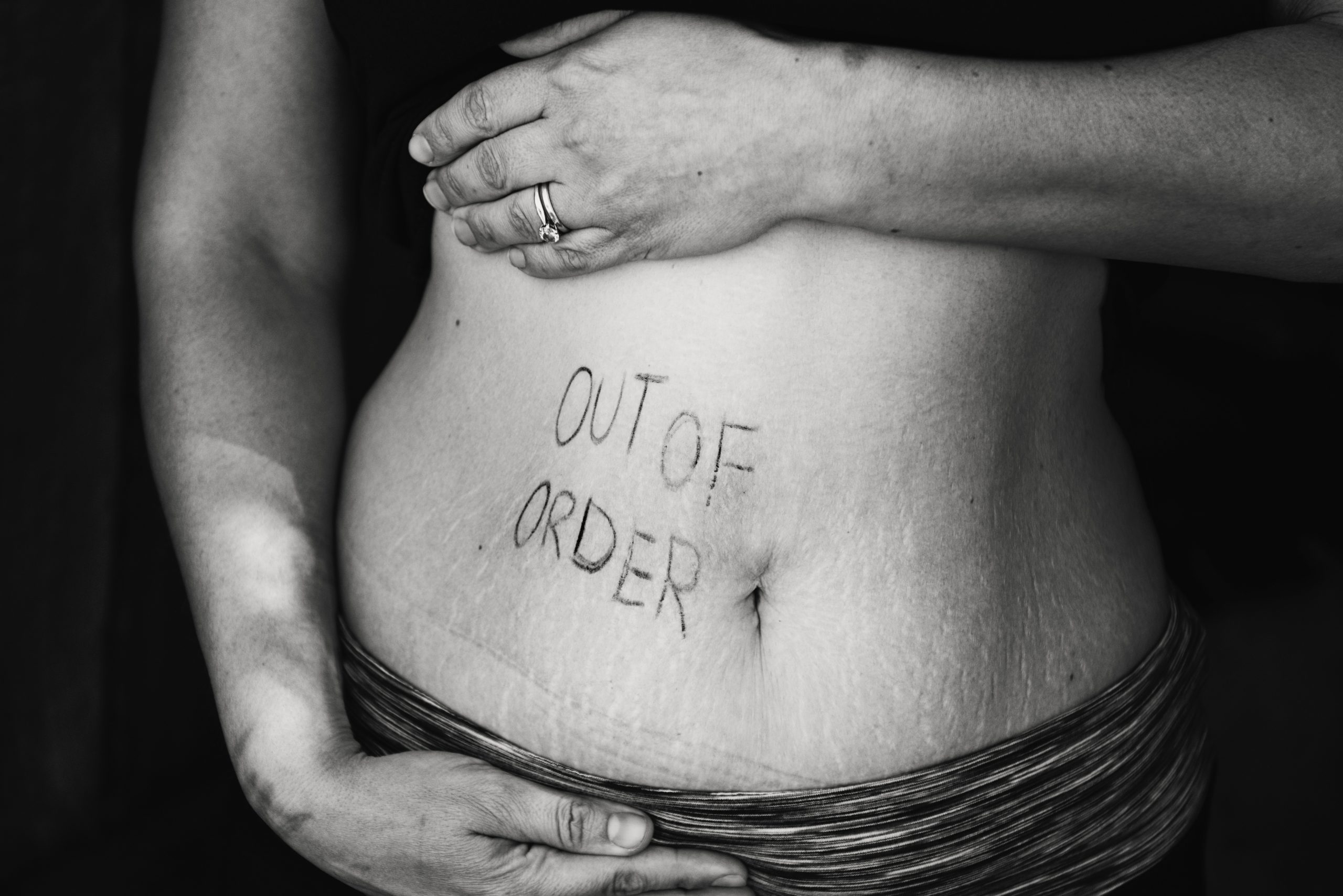 diastasis-informacion