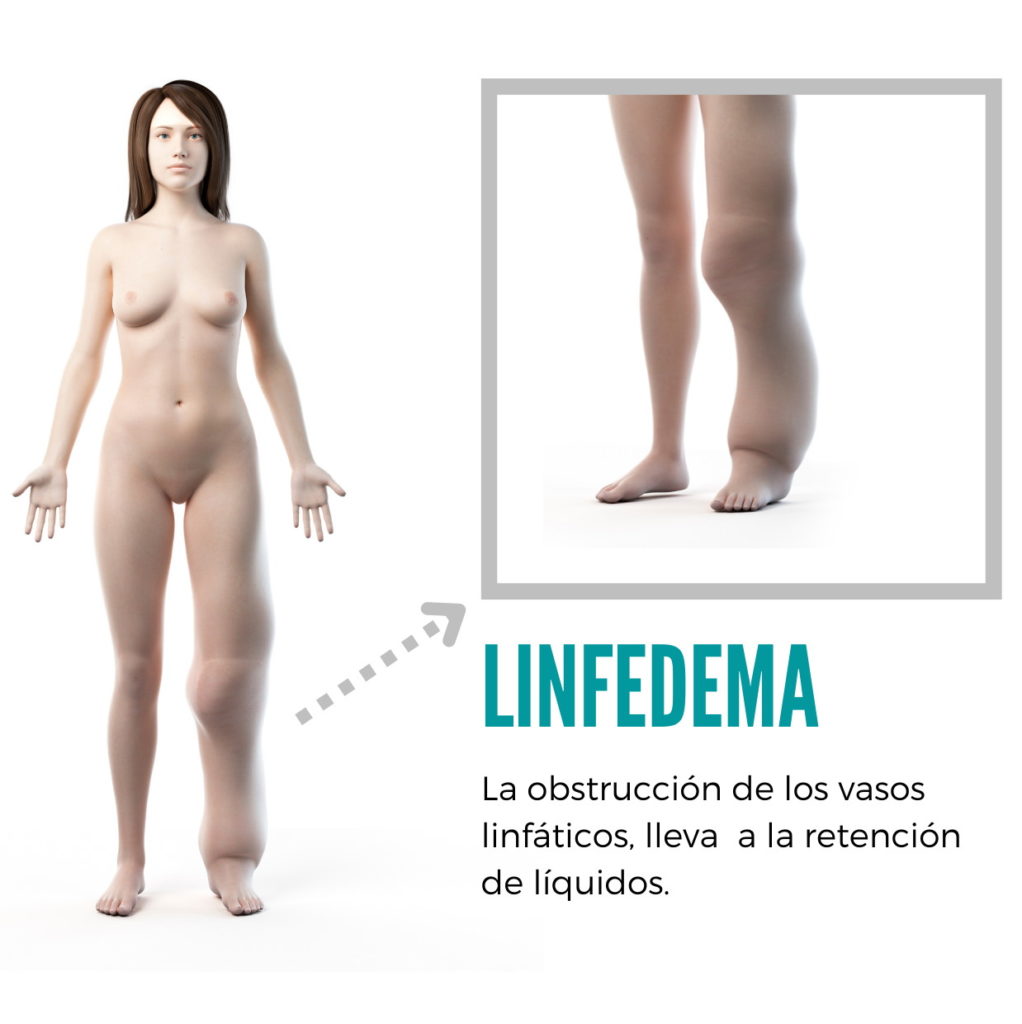 linfedema-que-es-fisioterapia-vicetto-infografia