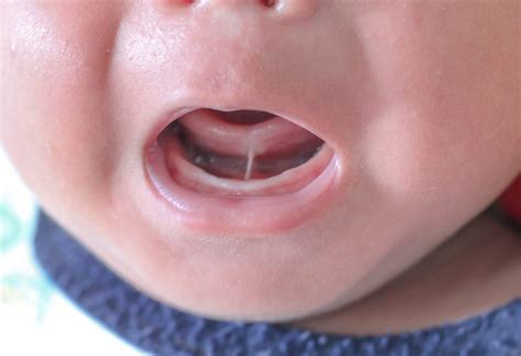 frenillo-en-bebe-frenotomia-fisioterapia