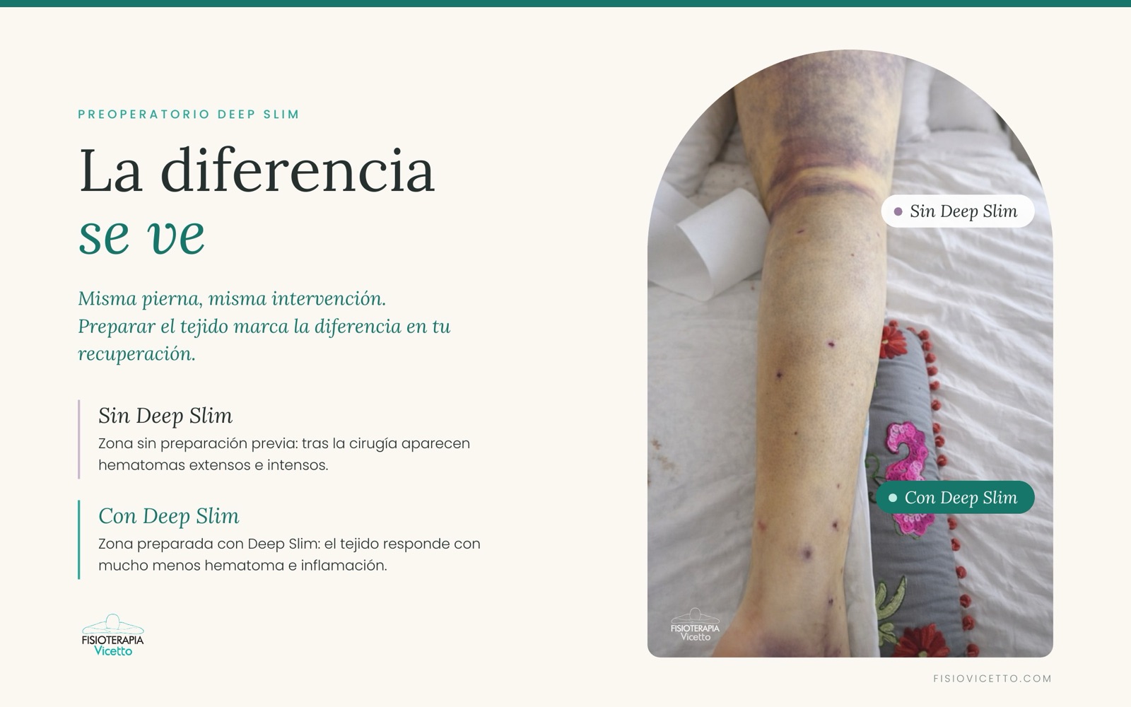 Pierna tras cirugía de lipedema: zona sin Deep Slim con hematomas extensos y zona preparada con Deep Slim con mucho menos hematoma e inflamación
